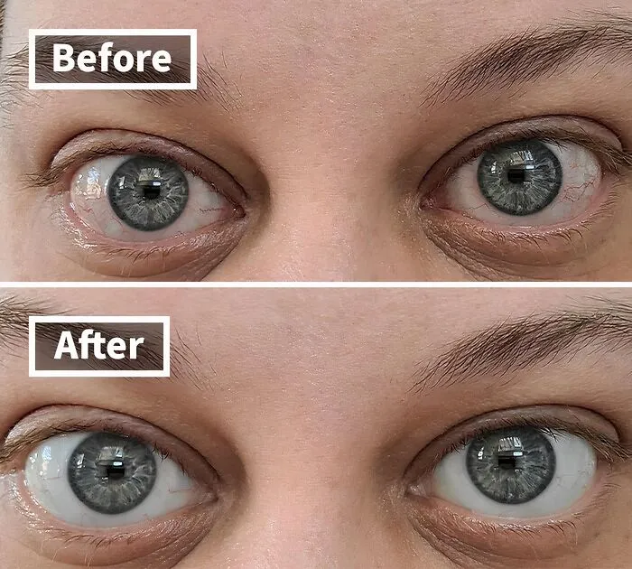 Before: Red, Irritated Eyes That Scream "I've Been Staring At A Screen All Day" (Or "I Had One Too Many Margaritas Last Night") <br><br> After: <a Style="Display:inline;" Href="Https://Www.amazon.com/Lumify-Redness-Reliever-Drops-2-5ml/Dp/B07cdn39dp?ie=utf8&linkcode=ll1&tag=bpbobcat-20&linkid=668065d6bd5c33e35ded8c07a071d965&language=en_us&ref_=as_li_ss_tl" Target="_blank"><span Style="Font: Inherit; Color: #d74b1f;"> Redness Reliever Eye Drops</Span> Work Their Magic, Bringing Back The Sparkle And Clarity To Your Peepers, So You Can Face The World With Confidence