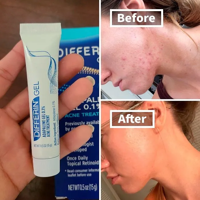 Clear Skin Ahead!   <a Style="Display:inline;" Href="Https://Www.amazon.com/Differin-Adapalene-0-1-Acne-Treatment/Dp/B07l1phsy9?th=1&linkcode=ll1&tag=bpscorpion-20&linkid=f8e08ab44e3953a0764dec3b6196f3c3&language=en_us&ref_=as_li_ss_tl " Target="_blank"><span Style="Font: Inherit; Color: #d74b1f;"> Differin Acne Treatment Gel</Span> Is Like A 'Glow Up' Potion For Your Face -  Bye-Bye Breakouts!