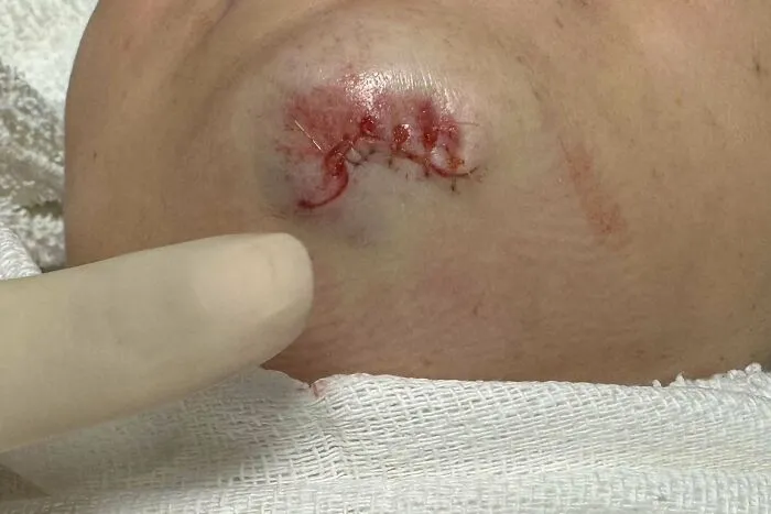 Fell Off My Bike And Had To Get Stitches On The Way To My First Day Of Senior Year LOL