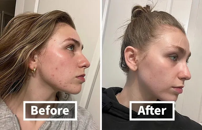 Wave Goodbye To Those Pesky Post-Acne Marks And Hello To A Smoother, More Even Complexion With This   <a Style="Display:inline;" Href="Https://Www.amazon.com/CeraVe-Post-Acne-Refining-Resurfacing-Brightening/Dp/B07vwsn95s?ie=utf8&linkcode=ll1&tag=bpbuffalo-20&linkid=1a496f04041aa88d2d54fdaa9ce8e805&language=en_us&ref_=as_li_ss_tl " Target="_blank"><span Style="Font: Inherit; Color: #d74b1f;"> CeraVe Retinol Serum</Span>