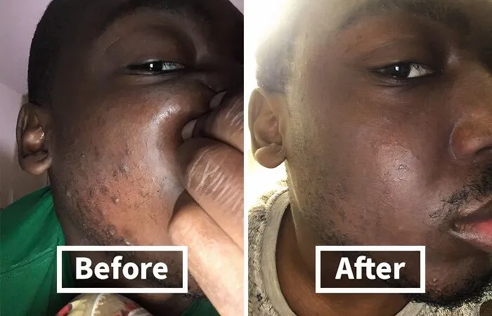 Razor Bumps Got You Feeling Prickly?   <a Style="Display:inline;" Href="Https://Www.amazon.com/Tend-Skin-Solution-Unsightly-Ingrown/Dp/B001ecq7g4?ie=utf8&linkcode=ll1&tag=bpbuffalo-20&linkid=23dbbf1f806bf0cd70a383b911354afa&language=en_us&ref_=as_li_ss_tl " Target="_blank"> <span Style="Font: Inherit; Color: #d74b1f;"> Tend Skin Solution</Span> Will Smooth Things Over Faster Than A Hot Knife Through Butter