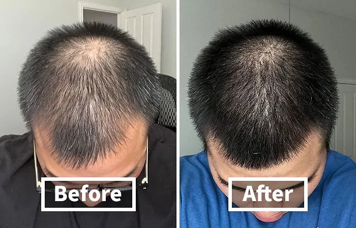 Your Hair Might Be Thinning, But Your Confidence Doesn't Have To Be!    <a Style="Display:inline;" Href="Https://Www.amazon.com/Biotin-Hair-Shampoo-Thinning-Moisturizing/Dp/B01encboa0?ie=utf8&linkcode=ll1&tag=bpfish-20&linkid=a69bb1483200891f75b96d97dee6d94d&language=en_us&ref_=as_li_ss_tl " Target="_blank"><span Style="Font: Inherit; Color: #d74b1f;"> Rosemary And Biotin Shampoo</Span> Is Here To Help You Reclaim Your Crown