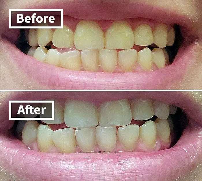 Your Smile Is About To Get A Serious Glow-Up With This   <a Style="Display:inline;" Href="Https://Www.amazon.com/Venus-Visage-Effective%ef%bc%86painless-Sensitivity-Travel-Friendly/Dp/B082x2gsgj?ie=utf8&linkcode=ll1&tag=bpfish-20&linkid=b25902c17753aa98e5a8fa257fc6e2ce&language=en_us&ref_=as_li_ss_tl " Target="_blank"><span Style="Font: Inherit; Color: #d74b1f;"> Teeth Whitening Pen</Span>
