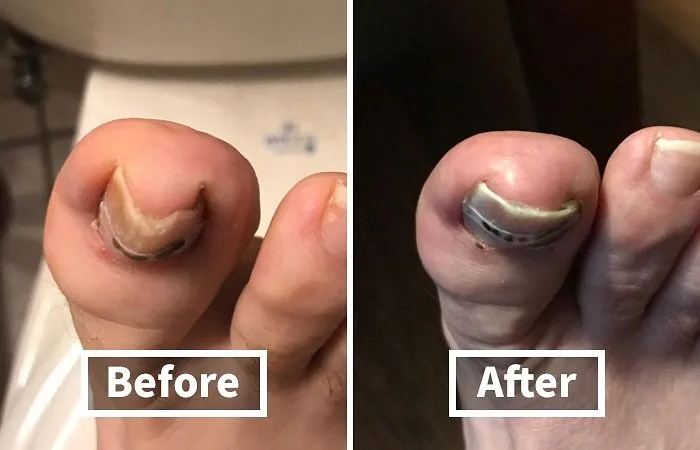 Don't Let Your Toes Become A Horror Story. This   <a Style="Display:inline;" Href="Https://Www.amazon.com/Curvecorrect-Ingrown-Treatment-Correction-Standard/Dp/B007oyke6a?ie=utf8&linkcode=ll1&tag=bpfish-20&linkid=f9194f1334b15822c2057116c3b173f2&language=en_us&ref_=as_li_ss_tl " Target="_blank"><span Style="Font: Inherit; Color: #d74b1f;"> Ingrown Toenail Home Treatment</Span> Is The Gentle Nudge Your Nails Need To Stay In Line