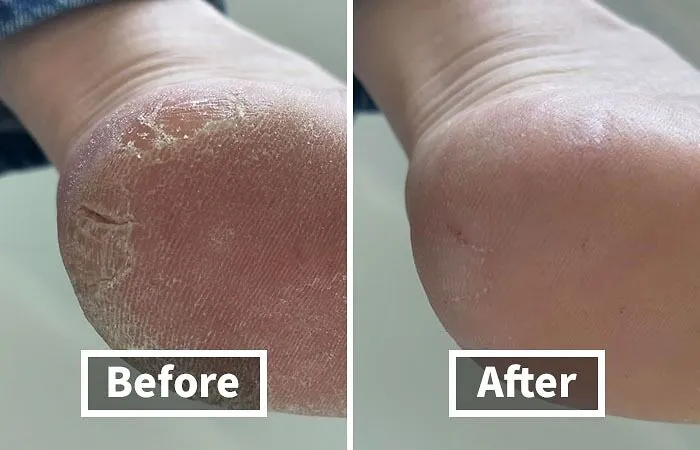 Your Feet Will Be Sandal-Ready In No Time With This   <a Style="Display:inline;" Href="Https://Www.amazon.com/Colossal-Remover-Pedicure-Surgical-Stainless/Dp/B00vpvevsk?ie=utf8&linkcode=ll1&tag=bpfish-20&linkid=aa25db69a4d566d2685eddd1c7405490&language=en_us&ref_=as_li_ss_tl " Target="_blank"><span Style="Font: Inherit; Color: #d74b1f;"> Foot File And Callus Remover</Span> - No More Hiding Those Rough Heels In Shame!