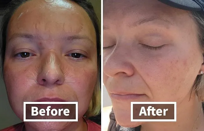 Pimple Emergency?  <span Style="Font: Inherit; Color: #d74b1f;">mighty Patch</Span> To The Rescue!  These Hydrocolloid Patches Will Shrink Those Blemishes Faster Than You Can Say "Selfie"