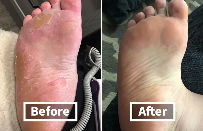 Don't Let Dry, Rough Feet Hold You Back From Living Your Best Life.  A <a Style="Display:inline;" Href="Https://Www.amazon.com/Foot-Peel-Callus-Mask-Dry/Dp/B078wctvv9?ie=utf8&linkcode=ll1&tag=bpfish-20&linkid=eb3c1c62dde9118fe4bb2153e10ed3dd&language=en_us&ref_=as_li_ss_tl " Target="_blank"><span Style="Font: Inherit; Color: #d74b1f;"> Foot Peel Mask</Span> Is The Key To Stepping Out With Confidence