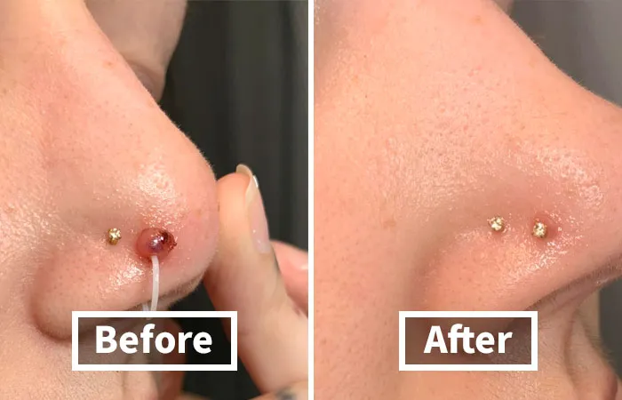 Don't Let Those Little Bumps Steal Your Thunder!   <a Style="Display:inline;" Href="Https://Www.amazon.com/Dp/B09qh56drc?ascsubtag=7713101%2c7%2c37%2cd%2c0%2c0%2cbf-Web-Hf%2c900%3a2%3b974%3a1%3b1125%3a1%3b1338%3a1%2c49764504%2c0%2c0%2c0&btn_ref=srctok-860c299ccea18a06&th=1&linkcode=ll1&tag=bpfish-20&linkid=ca84a321a3e19992dd8ed968a33b0173&language=en_us&ref_=as_li_ss_tl " Target="_blank"><span Style="Font: Inherit; Color: #d74b1f;"> Piercing Bump Solution & Keloid Bump Removal</Span> Duo Is The Dynamic Duo Your Piercings Have Been Waiting For