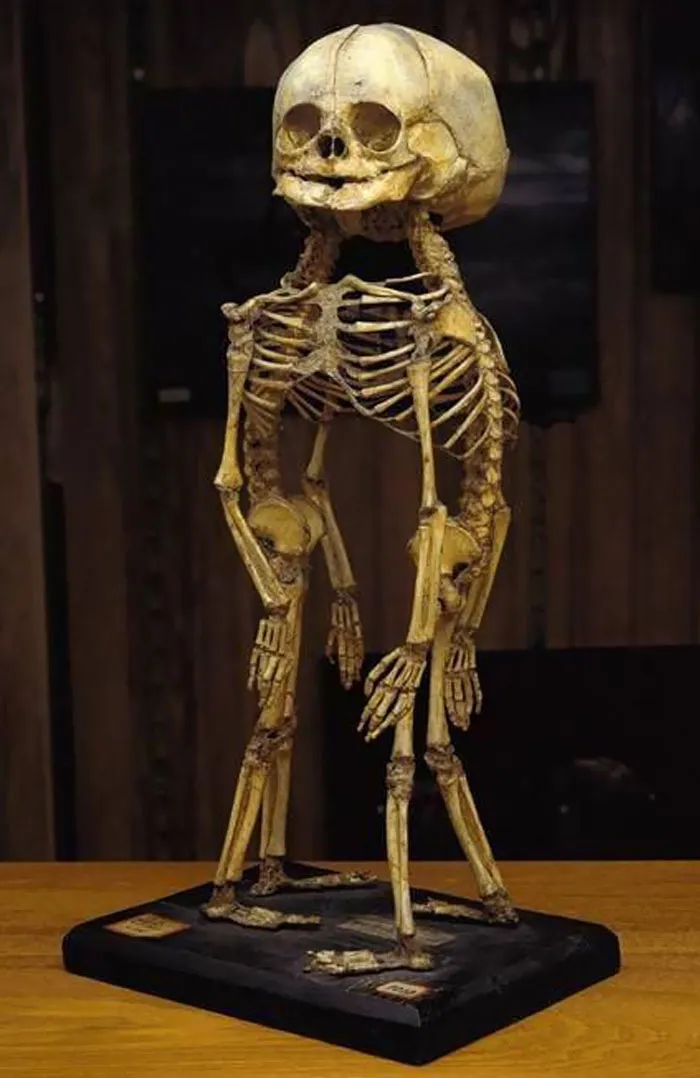 Esqueleto de siameses en el Museo Mütter
