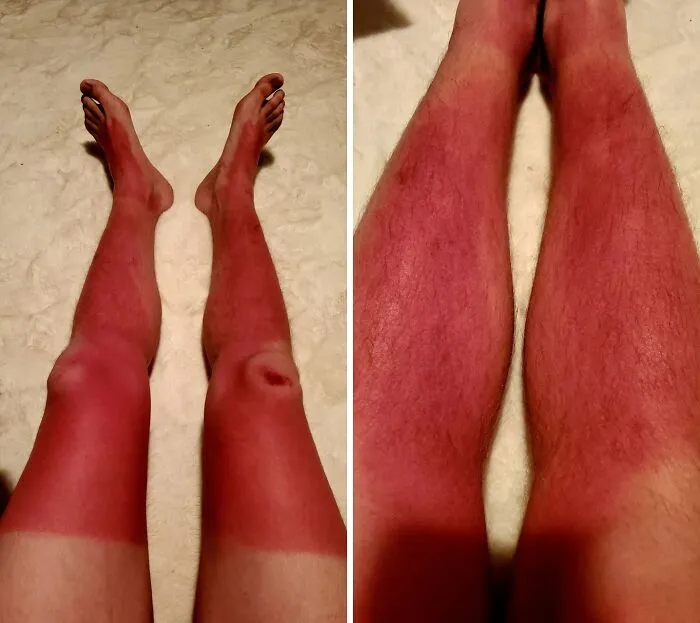 "I guess my sunscreen wasn't water resistant" - <span Style="Font:inherit;color:#808080"> Pale-Equal</Span>