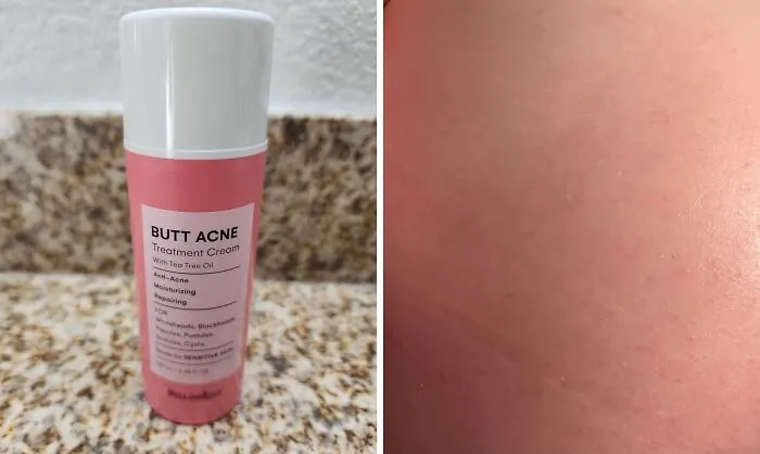 Booty Breakouts Got You Down? This <a Style="Display:inline;" Href="Https://Www.amazon.com/Bellamiluxx-Clearing-Extracts-Moisture-Buttocks/Dp/B08lsr6swg?ie=utf8&linkcode=ll1&tag=bpsnail-20&linkid=f6acbf33d4cdba2eb6b0baa2d0272698&language=en_us&ref_=as_li_ss_tl" Target="_blank"><span Style="Font: Inherit; Color: #d74b1f;"> Butt Acne Clearing Lotion</Span> Is Here To Save Your, Well, You Know