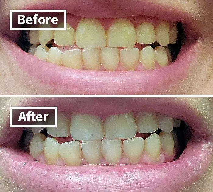 Want A Hollywood Smile Without The Awkward Dentist Visit?  The <a Style="Display:inline;" Href="Https://Www.amazon.com/Venus-Visage-Effective%ef%bc%86painless-Sensitivity-Travel-Friendly/Dp/B082x2gsgj?ie=utf8&linkcode=ll1&tag=bpsnail-20&linkid=cd3f93dada8c9ad9039c4df52cbb5f68&language=en_us&ref_=as_li_ss_tl" Target="_blank"><span Style="Font: Inherit; Color: #d74b1f;"> Venus Visage Teeth Whitening Pen</Span> Is Your Secret Weapon For Pearly Whites