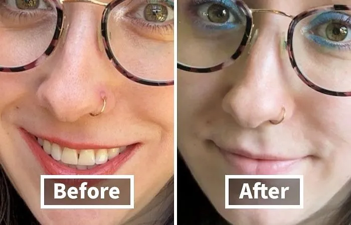 Keep Your Piercings Looking Flawless, Even If They're Acting A Little Rebellious. This <a Style="Display:inline;" Href="Https://Www.amazon.com/Piercing-Treatment-Removal-Soothing-Aftercare/Dp/B09qh56drc?ie=utf8&linkcode=ll1&tag=bpsnail-20&linkid=881b905860cef7ebe051a60f3402aed5&language=en_us&ref_=as_li_ss_tl" Target="_blank"><span Style="Font: Inherit; Color: #d74b1f;"> Base Laboratories Piercing Bump Solution</Span> Has Your Back