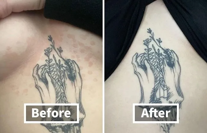 Don't Let Embarrassing Skin Problems Cramp Your Style. Order <a Style="Display:inline;" Href="Https://Www.amazon.com/Remedy-Antifungal-Wash-Infections-Irritations/Dp/B00r1p82uw?ie=utf8&linkcode=ll1&tag=bpsnail-20&linkid=12490e7bff1c78abd0e02a09ab60097f&language=en_us&ref_=as_li_ss_tl" Target="_blank"><span Style="Font: Inherit; Color: #d74b1f;"> Truremedy Tea Tree Body Wash</Span> Online And Reclaim Your Confidence