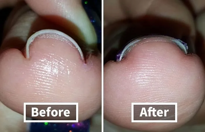 Embarrassed About Your Ingrown Toenails?  We Get It. That's Why This <a Style="Display:inline;" Href="Https://Www.amazon.com/Curvecorrect-Ingrown-Treatment-Correction-Standard/Dp/B007oyke6a?ie=utf8&linkcode=ll1&tag=bpsnail-20&linkid=e5973d4075f2fc1d046965f4784e7eba&language=en_us&ref_=as_li_ss_tl" Target="_blank"><span Style="Font: Inherit; Color: #d74b1f;"> Ingrown Toenail Home Treatment</Span> Is The Perfect Solution For A Little DIY Foot TLC