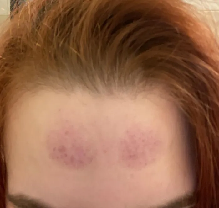 "I didn’t think the suction cups were that strong on my forehead. I have work today. Is concealer my only hope? I regret this so much." - <span Style="Font:inherit;color:#808080"> Able_Distribution209</Span>