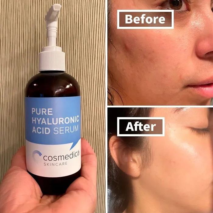 Hydrate, Plump, And Glow: Experience Youthful Skin With This <a Style="Display:inline;" Href=" Https://Www.amazon.com/Dp/B0090ujfyi?ascsubtag=7716194%2c20%2c45%2cd%2c0%2c0%2cbf-Web-Hf%2c900%3a2%3b974%3a3%3b1125%3a3%3b1338%3a1%2c0%2c0%2c0&_encoding=utf8&btn_ref=srctok-Da6cc495fd72681d&th=1&linkcode=ll1&tag=bplobster-20&linkid=a1bf1b76206feed5317f5a9e15d5d0ff&language=en_us&ref_=as_li_ss_tl " Target="_blank"><span Style="Font:inherit;color:#d74b1f;"> Pure Hyaluronic Acid Serum</Span>!