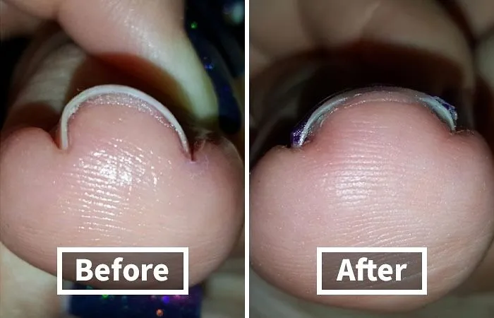 "I got a nasty ingrown toenail because I put on and attended practice in soccer shoes that were two sizes too small. They were the exact pair as my normal shoes, I don't know why I kept them" - <span Style="Font:inherit;color:#808080"> Nalgas4497</Span>