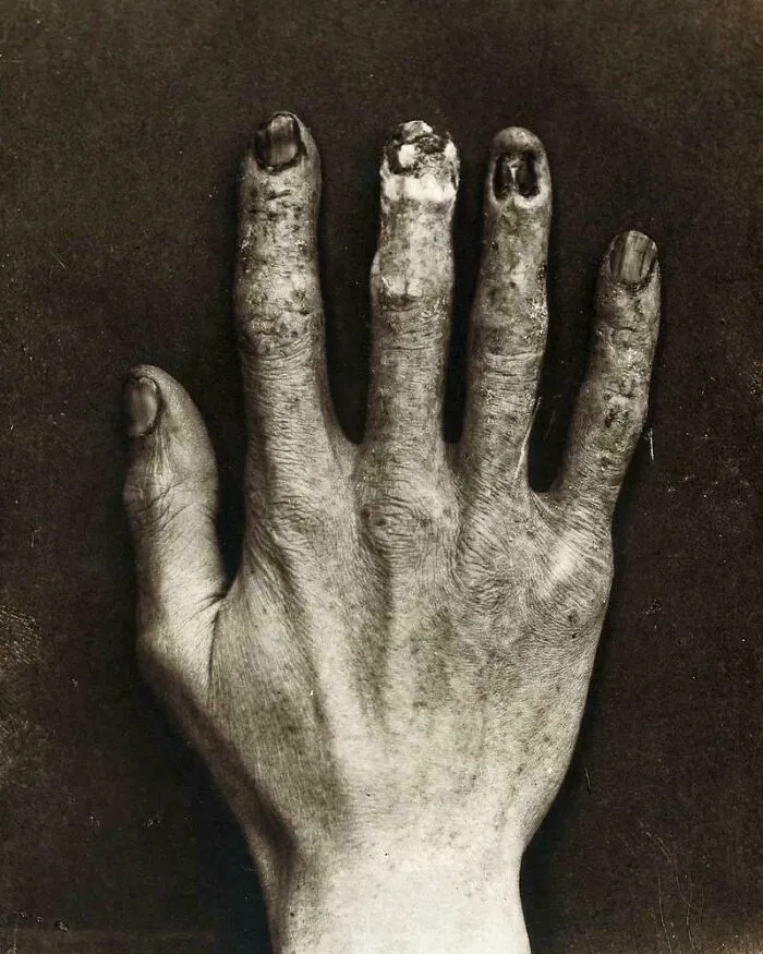 Hand Belonging To An X-Ray Technician At The Royal London Hospital, Showing Damage Caused By Radiation Exposure, 1900