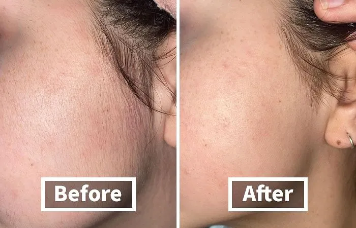 <a Style="Display:inline;" Href=" Https://Www.amazon.com/Schick-Multipurpose-Exfoliating-Dermaplaning-Precision/Dp/B0787glbmv?ie=utf8&linkcode=ll1&tag=bpbee-20&linkid=699589e8b253e9510bc47ee595649f77&language=en_us&ref_=as_li_ss_tl " Target="_blank"> <span Style="Font: Inherit; Color: #d74b1f;"> Dermaplane Razor</Span> – Achieve Flawless, Radiant Skin With Precision And Ease