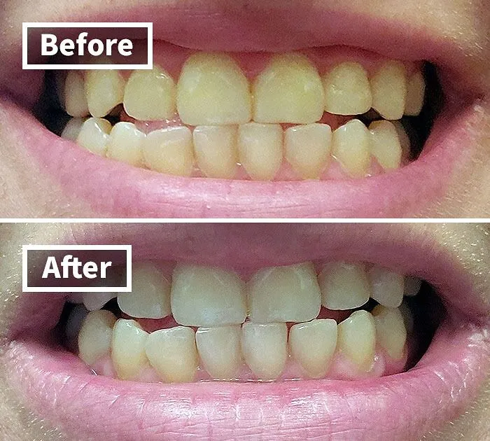 Your Pearly Whites Are About To Get Even Brighter With This <a Style="Display:inline;" Href="Https://Www.amazon.com/Venus-Visage-Effective%ef%bc%86painless-Sensitivity-Travel-Friendly/Dp/B082x2gsgj?ie=utf8&linkcode=ll1&tag=bpgnu-20&linkid=d1260d6601662b3fb04bc0c6a7d1e02f&language=en_us&ref_=as_li_ss_tl" Target="_blank"><span Style="Font: Inherit; Color: #d74b1f;"> Winning Teeth Whitening Pen</Span>