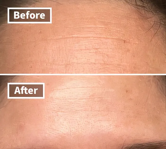 Botox?  Nah.  These <a Style="Display:inline;" Href="Https://Www.amazon.com/Frownies-Forehead-Between-Eyes-Patches/Dp/B00027dmsi?ie=utf8&linkcode=ll1&tag=bpgnu-20&linkid=f1ed306b600b19cbbe57fc8a3b04a009&language=en_us&ref_=as_li_ss_tl" Target="_blank"><span Style="Font: Inherit; Color: #d74b1f;"> Wrinkle Patches</Span> Are The Affordable (And Pain-Free!) Way To Turn Back The Clock On Your Forehead
