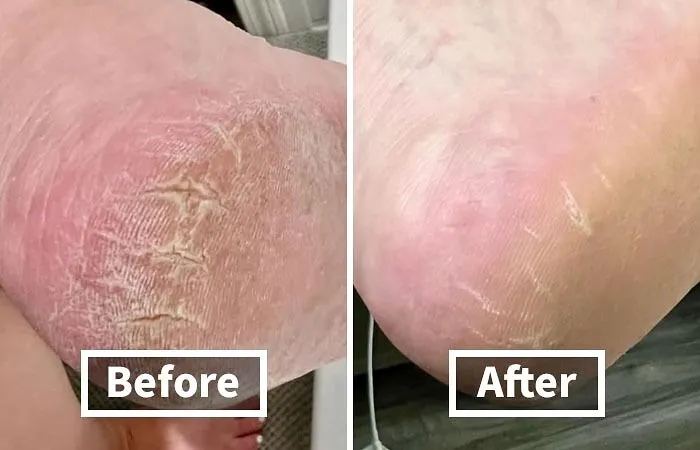 Say "Goodbye" To Sandpaper Feet And "Hello" To Baby-Soft Heels With This <a Style="Display:inline;" Href="Https://Www.amazon.com/Dr-Scholls-Cracked-Moisturizes-Healthy/Dp/B08yzbbvgk?ie=utf8&linkcode=ll1&tag=bpgnu-20&linkid=b616a6b62d6144df3f39325d1e8ba0fd&language=en_us&ref_=as_li_ss_tl" Target="_blank"><span Style="Font: Inherit; Color: #d74b1f;"> Cracked Heel Repair Balm</Span>