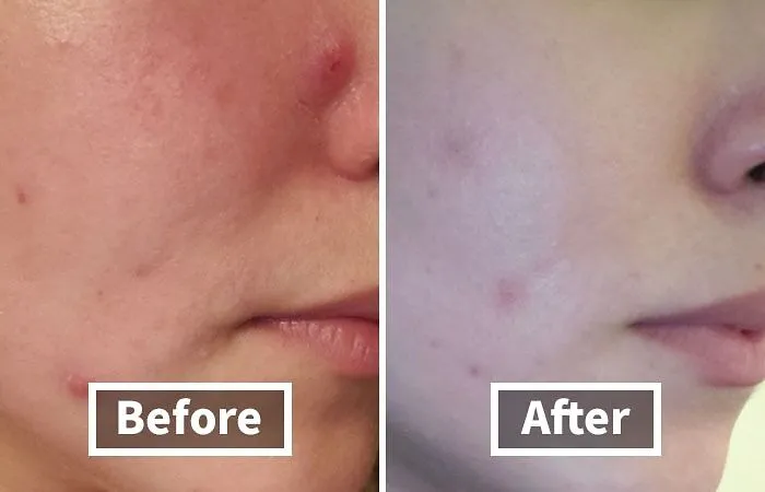 Breakouts And Blackheads? Not On Our Watch!" This <a Style="Display:inline;" Href="Https://Www.amazon.com/Paulas-Choice-Skin-Perfecting-Salicylic-Exfoliant/Dp/B07d8dbs7s?ie=utf8&linkcode=ll1&tag=bpkomodo-20&linkid=378891f7d14d61693481284478a62b37&language=en_us&ref_=as_li_ss_tl " Target="_blank"><span Style="Font: Inherit; Color: #d74b1f;"> Paula's Choice Exfoliant Duo</Span> Is The Dynamic Duo Your Skin Needs To Fight Back