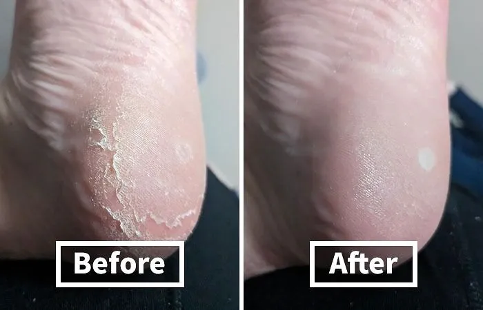 Say Goodbye To Rough, Cracked Heels And Hello To Silky-Smooth Feet With This   <a Style="Display:inline;" Href="Https://Www.amazon.com/Colossal-Remover-Pedicure-Surgical-Stainless/Dp/B00vpvevsk?ie=utf8&linkcode=ll1&tag=bpdonkey-20&linkid=ad301c599e20498feae9079cfb60b5fa&language=en_us&ref_=as_li_ss_tl" Target="_blank"><span Style="Font: Inherit; Color: #d74b1f;"> Colossal Foot Rasp</Span>