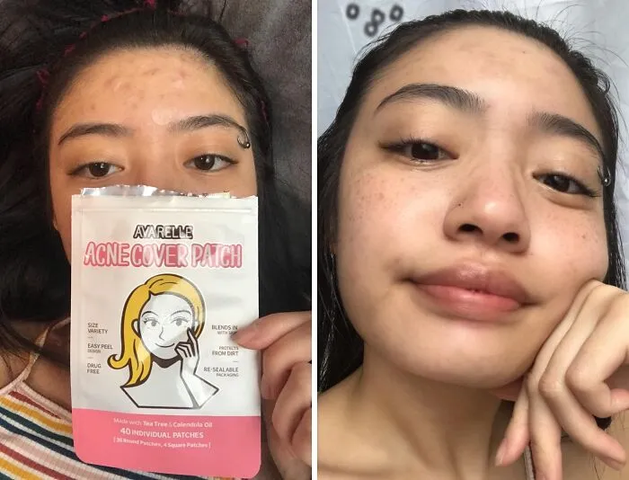 Breakouts Got You Down? Stick It To Them With These    <a Style="Display:inline;" Href="Https://Www.amazon.com/Avarelle-Pimple-Patches-Eligible-Blemishes/Dp/B075qnc39q?ie=utf8&linkcode=ll1&tag=bpdonkey-20&linkid=9b5f5b8a05c0de001c58efc7ff7ec298&language=en_us&ref_=as_li_ss_tl" Target="_blank"><span Style="Font: Inherit; Color: #d74b1f;"> Acne Cover Patches</Span> And Say "Peace Out, Pimples!"