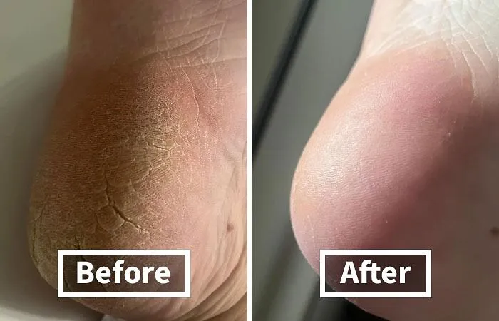 Calluses Got You Feeling Like You've Been Walking On Hot Coals?  Cool Down And Smooth Out Those Rough Patches With This   <a Style="Display:inline;" Href="Https://Www.amazon.com/Colossal-Remover-Pedicure-Surgical-Stainless/Dp/B00vpvevsk?ie=utf8&linkcode=ll1&tag=bppanda-20&linkid=b94fce6ad2aebb4da41092f52782aeb5&language=en_us&ref_=as_li_ss_tl " Target="_blank"><span Style="Font: Inherit; Color: #d74b1f;"> Foot File And Callus Remover</Span>