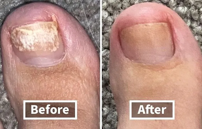 Nail Fungus Got Your Toes Looking Like A Science Experiment Gone Wrong? This   <a Style="Display:inline;" Href="Https://Www.amazon.com/Kerasal-Fungal-Nail-Renewal-Visible/Dp/B007adol28?ie=utf8&th=1&linkcode=ll1&tag=bppanda-20&linkid=4a18c0fcd1984ef06f4144b7e42650be&language=en_us&ref_=as_li_ss_tl " Target="_blank"><span Style="Font: Inherit; Color: #d74b1f;"> Kerasal Nail Renewal</Span> Will Have Them Looking Healthy And Sandal-Ready In No Time! 