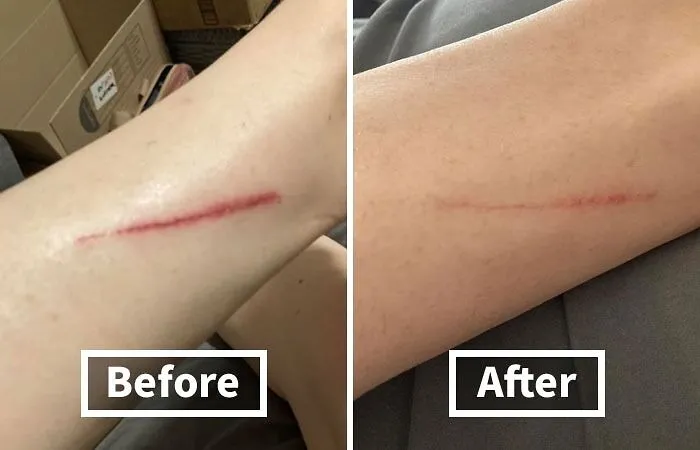Stretch Marks And Scars Got You Feeling Less Than Fabulous?   <a Style="Display:inline;" Href="Https://Www.amazon.com/Bio-Oil-Skincare-Vitamin-Stretchmarks-Moisturizer/Dp/B000vppuea?ie=utf8&linkcode=ll1&tag=bppanda-20&linkid=ce256a950b4b94d34d947847c3b3ba1a&language=en_us&ref_=as_li_ss_tl " Target="_blank"><span Style="Font: Inherit; Color: #d74b1f;"> Bio-Oil</Span> Is Here To The Rescue! 