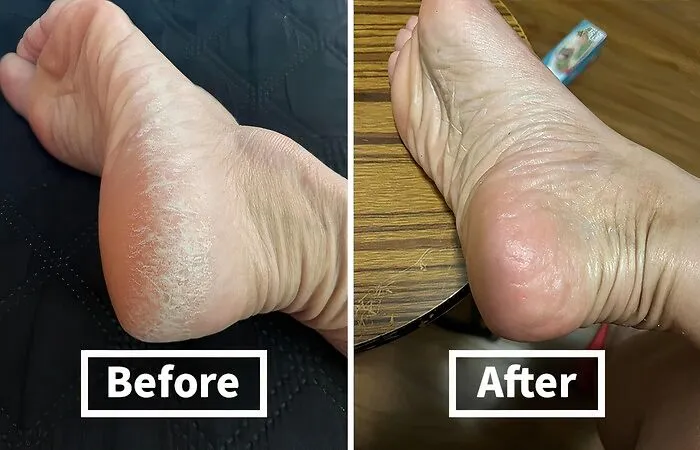 Calluses Got Your Feet Feeling Like Sandpaper?  Say 'Adios' To Rough Patches With This   <a Style="Display:inline;" Href="Https://Www.amazon.com/Dp/B01ncmjpoq?ascsubtag=7729703%2c7%2c34%2cd%2c0%2c0%2cbf-Web-Hf%2c900%3a2%3b974%3a3%3b1125%3a1%3b1338%3a1%2c0%2c0%2c0%2c0&btn_ref=srctok-E5d76be7b0aaadc1&linkcode=ll1&tag=bpshark-20&linkid=468be11a3ae499d253d08114564b96ba&language=en_us&ref_=as_li_ss_tl" Target="_blank"><span Style="Font: Inherit; Color: #d74b1f;"> Callus Remover Gel</Span> 