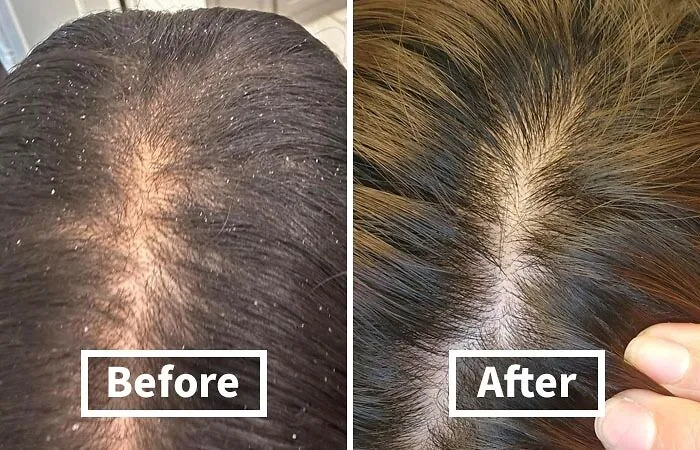 Dandruff Got You Feeling Like A Walking Snow Globe?  Shake It Off With This   <a Style="Display:inline;" Href="Https://Www.amazon.com/Nizoral-Anti-Dandruff-Shampoo-Ketoconazole-Dandruff/Dp/B00ainmfac?ie=utf8&linkcode=ll1&tag=bppanda-20&linkid=2c97a6f5afeda4283ef6d96e10b58b49&language=en_us&ref_=as_li_ss_tl " Target="_blank"><span Style="Font: Inherit; Color: #d74b1f;"> Nizoral Shampoo</Span> And Say Hello To A Flake-Free Scalp! 