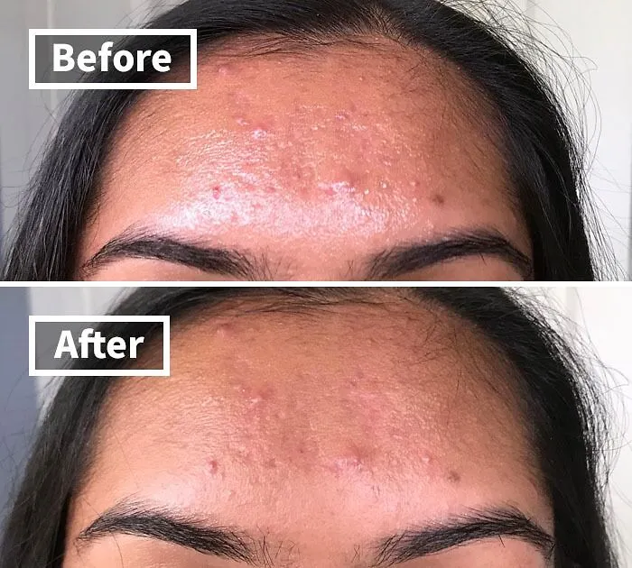 Oily Skin Got You Feeling Like A Glazed Donut? <a Style="Display:inline;" Href="Https://Www.amazon.com/Natural-Green-Tea-Absorbing-Tissues/Dp/B017oy602q?ie=utf8&linkcode=ll1&tag=bppanda-20&linkid=ef2fb67a8a0ca4f1362fb658643bb32d&language=en_us&ref_=as_li_ss_tl " Target="_blank"><span Style="Font: Inherit; Color: #d74b1f;"> Green Tea Oil Absorbing Tissues</Span> Will Have You Matte And Shine-Free In Seconds!