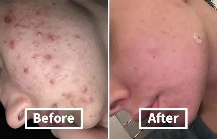 Breakouts Got You Feeling Like A Teenager Again? Kiss Those Pesky Pimples Goodbye With This   <a Style="Display:inline;" Href="Https://Www.amazon.com/Dp/B014hyi86m?ascsubtag=7732592%2c18%2c31%2cd%2c0%2c0%2cbf-Web-Hf%2c900%3a2%3b974%3a3%3b1125%3a1%3b1338%3a1%2c0%2c0%2c0&ie=utf8%25252c0%252c0%2c0&btn_ref=srctok-B833b6d74420c0a4&linkcode=ll1&tag=bpshark-20&linkid=d45d266e1368290d80ee76cf78342111&language=en_us&ref_=as_li_ss_tl" Target="_blank"><span Style="Font: Inherit; Color: #d74b1f;"> Anti-Acne Soap</Span>! 