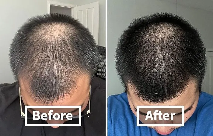 Hair Looking A Little Sparse? This   <a Style="Display:inline;" Href="Https://Www.amazon.com/Biotin-Hair-Shampoo-Thinning-Moisturizing/Dp/B01encboa0?ie=utf8&linkcode=ll1&tag=bpzebra-20&linkid=c132fb04194a99e31bfd3451e2589eab&language=en_us&ref_=as_li_ss_tl" Target="_blank"><span Style="Font: Inherit; Color: #d74b1f;"> Rosemary & Biotin Shampoo</Span> Will Give Your Locks The Boost They Need To Thrive!