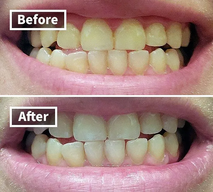 A   <a Style="Display:inline;" Href="Https://Www.amazon.com/Venus-Visage-Effective%ef%bc%86painless-Sensitivity-Travel-Friendly/Dp/B082x2gsgj?ie=utf8&linkcode=ll1&tag=bpzebra-20&linkid=73c6781fcee929448c2fe62233054ca4&language=en_us&ref_=as_li_ss_tl" Target="_blank"><span Style="Font: Inherit; Color: #d74b1f;"> Venus Visage Award Winning Teeth Whitening Pen</Span> Will Have You Beaming Brighter Than A Hollywood Starlet