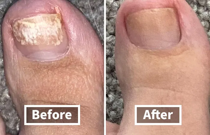 Nail Problems Got You Hiding Your Toes In Shame? We've All Been There. Thankfully, <a Style="Display:inline;" Href="Https://Www.amazon.com/Kerasal-Fungal-Nail-Renewal-Visible/Dp/B007adol28?ie=utf8&linkcode=ll1&tag=bpsnail-20&linkid=5af12b120152f3225d9e31b839a6e4c4&language=en_us&ref_=as_li_ss_tl" Target="_blank"><span Style="Font: Inherit; Color: #d74b1f;"> Kerasal Nail Renewal</Span> Exists
