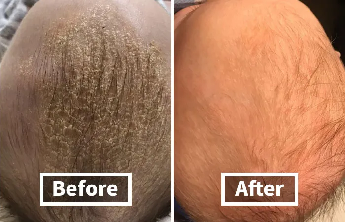 Baby's Got Flakes?  Tackle That Cradle Cap Discreetly With This <a Style="Display:inline;" Href="Https://Www.amazon.com/Safety-1st-Cradle-Brush-Comb/Dp/B011evxiie?ie=utf8&linkcode=ll1&tag=bpsnail-20&linkid=3b5904012916ac41677ae7a7b3568a74&language=en_us&ref_=as_li_ss_tl" Target="_blank"><span Style="Font: Inherit; Color: #d74b1f;"> Safety 1st Cradle Cap Brush And Comb</Span> - No One Needs To Know About Your Little One's "Snow Problem"
