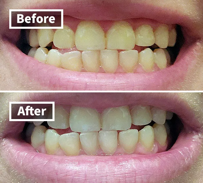 <a Style="Display:inline;" Href=" Https://Www.amazon.com/Venus-Visage-Effective%ef%bc%86painless-Sensitivity-Travel-Friendly/Dp/B082x2gsgj?ie=utf8&linkcode=ll1&tag=bpbee-20&linkid=6b131b4817c49ba507c3723647a6752c&language=en_us&ref_=as_li_ss_tl " Target="_blank"> <span Style="Font: Inherit; Color: #d74b1f;"> Teeth Whitening Pen</Span> – Your On-The-Go Secret To A Brighter, Whiter Smile