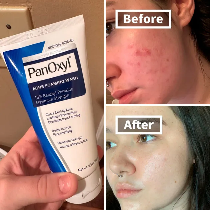 Clear Skin Starts Here: Powerful <a Style="Display:inline;" Href=" Https://Www.amazon.com/Panoxyl-Foaming-Peroxide-Strength-Antimicrobial/Dp/B081kl2qyj?crid=1halfrubk7da2&dib=eyj2ijoimsj9.m-Juxnr99vu7wi7_t9fkkmtrsnbiiob6ba2b930lvfw91m2gtwkgcixkjaflkzojennfd_wpjk-Zrn_xahq9bggzlfazmkujpbqqojhr3ueehw__tk-16a76xhujd0qdtwtdlft5gssq2pj5iyls97g3pezf5w2qq4de8j9dntev9itk6g0ysgh5u71xzs8e7mizwflh_xazqfpwd53qjz-98w2l9bwfjqanopezmcfy5gz6sm9norcfbcn7twklsczot-F8azkk1uzl4bjzelctrija8z3w94m1fs9868a.sopnnzo3zfbyjt6k8zr9i9kva_ixkckcxdgxkkevv6g&dib_tag=se&keywords=skincare&qid=1725870528&rdc=1&sprefix=skincar%2caps%2c348&sr=8-49&th=1&linkcode=ll1&tag=bplobster-20&linkid=27faa0e00b9a993e742e58d47607bc44&language=en_us&ref_=as_li_ss_tl " Target="_blank"><span Style="Font:inherit;color:#d74b1f;"> Panoxyl Acne Foaming Wash</Span> For Breakout-Free Beauty!