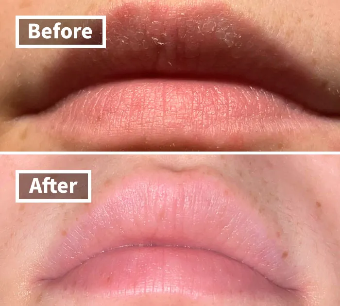For Dry Cracked Lips - <a Style="Display:inline;" Href=" Https://Www.amazon.com/Chapstick-Lip-Balm-Healing-Treatment/Dp/B000s2lt9q?crid=mrxiu0bjlgl1&dib=eyj2ijoimsj9.zeextdyscogmbiekn3gvvory3sbbzfuoqpdb5pskl_kzg6kxpnouvkwpaeurvbhayc7tkq8aqkxcma9yev-Vutjuw2lkxybxi2kihz9tupr4aooy36vwp7aahpo4xjaekkwz7g-Xdbqjkvik_xwzxltnxhnoooqttpzasasqdpabapwtzcmkyn3f6iqgtcyrtsuwgfvcqntpy0q7cwxdfngrpfoy9wzzzrellwq85f1prsak5kzqoosqbrnnw_esabhahzlm9wtl8ptmn0pazfvth6gm6e0-Fwltlpncnui.fwvvhrv2wu1gorbo58pxo7gihhv6sverx-Zcffwsq7q&dib_tag=se&keywords=lip%2brepair&qid=1725874429&sprefix=lip%2brep%2caps%2c393&sr=8-17&th=1&linkcode=ll1&tag=bplobster-20&linkid=33d78f65d83507cb93588428113e8abb&language=en_us&ref_=as_li_ss_tl " Target="_blank"><span Style="Font:inherit;color:#d74b1f;"> Healing Lip Balm</Span> For Severely Chapped Lips
