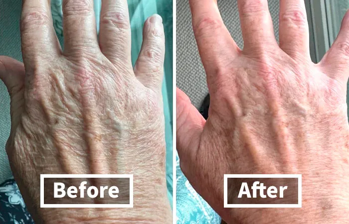 Experience Ageless Skin: <a Style="Display:inline;" Href=" Https://Www.amazon.com/Gold-Bond-Corrector-Smoothing-Concentrate/Dp/B08yqx3skh?crid=18wwbo27rpkij&dib=eyj2ijoimsj9.zfnaabgjltzrsqa6059wlenulfo-Bpmzlx-Vdmzozhjfp8s_as1cbeu92dmvatdacpzpn3bxoemtfmdbg3f5vrrdw24bejhpami9xs_wimpywgjdtfzh3ziyrsuqxwlozxg-Nrqi_gpkxlujksxcnpolyd4ofdz4ozzddpzaruqzh5h5fhreaaxe-Bd2l62nxtsb-Nbndimjdsdsqw1dlhxjepfhi0amfcgjqfqwdan1zxmzepcadj4jpeqc4b0xk7k8jdqqr4ebsnjiku4iyrbseadzzr8ofwuaoblwu2w.n4zovrnsfp-Xcxqdcv5us8yab_7sh9gi2ejd_icnuvg&dib_tag=se&keywords=body%2bcontouring%2bcream&qid=1725870300&rdc=1&sprefix=body%2bcontouring%2bcream%2caps%2c390&sr=8-1-Spons&sp_csd=d2lkz2v0tmftzt1zcf9hdgy&th=1&linkcode=ll1&tag=bplobster-20&linkid=c408ad69d8975f5e930754c4f8b4a777&language=en_us&ref_=as_li_ss_tl " Target="_blank"><span Style="Font:inherit;color:#d74b1f;"> Age Renew Body Lotion</Span> Fights Crepey Texture With Every Application!