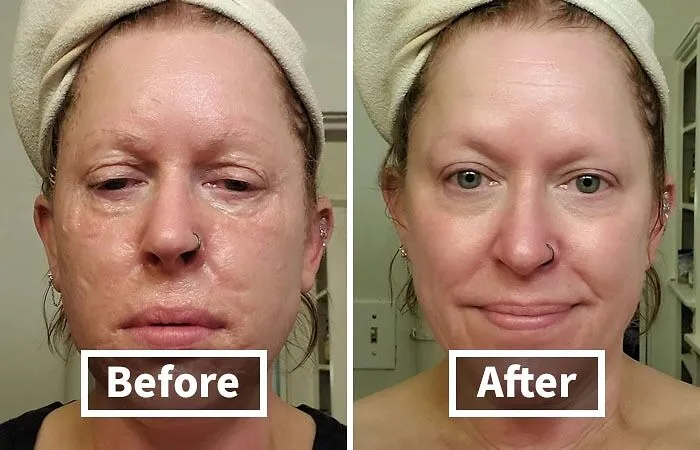 Tired Of Your Face Looking Like A Tired Zombie?  The <span Style="Font: Inherit; Color: #d74b1f;"> Skin1004 Hydrating Mask</Span> Will Bring Your Skin Back To Life With Its Hydrating And Tightening Powers (No Brains Required)