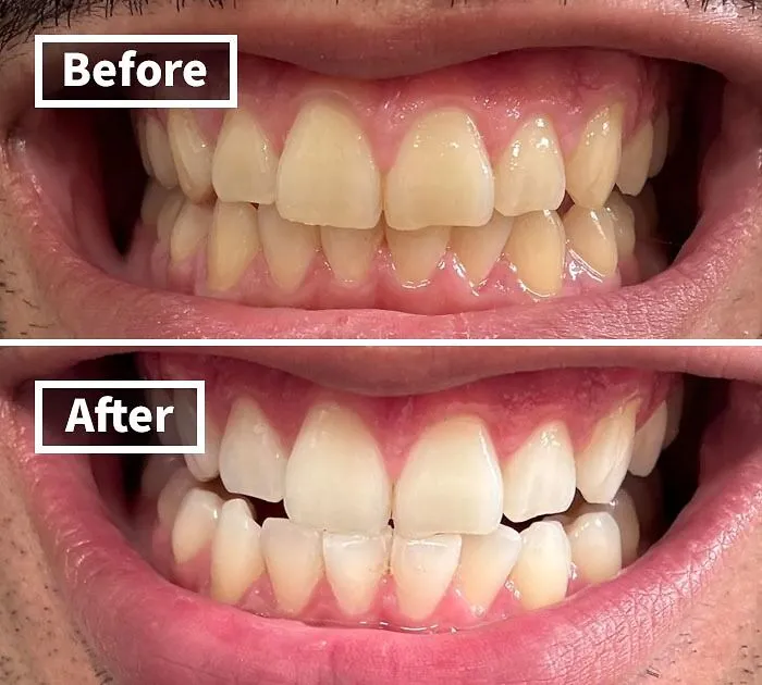 <a Style="Display:inline;" Href="Https://Www.amazon.com/Crest-Professional-Whitestrips-Whitening-Treatments/Dp/B00ahawwo0?ie=utf8&linkcode=ll1&tag=bpparrot-20&linkid=c5cb518d1b0dd4d17086eb73e0d8ee70&language=en_us&ref_=as_li_ss_tl" Target="_blank"><span Style="Font:inherit;color:#d74b1f;"> Crest 3D Whitestrips </Span> Gives You That Hollywood Smile Without The Hollywood Pricetag