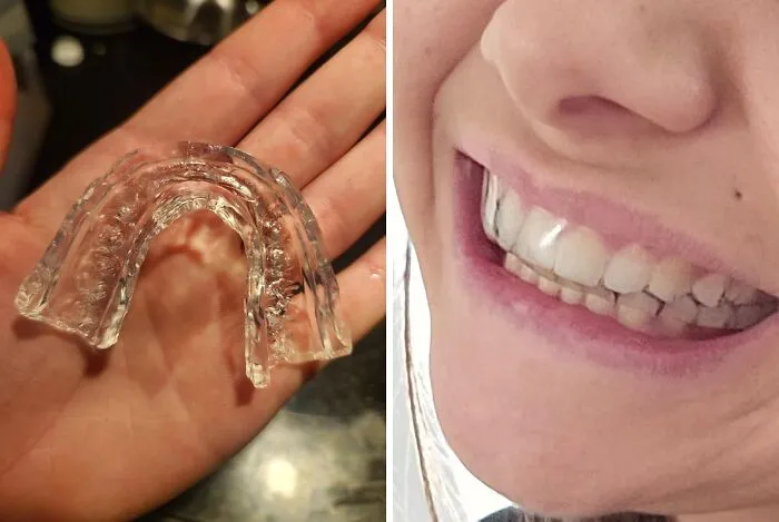 "Grinding Your Teeth Like A Dj Scratching A Record? This <a Style="Display:inline;" Href="Https://Www.amazon.com/Grinding-Clenching-Moldable-Prevent-Bruxism/Dp/B092m5w117?ie=utf8&linkcode=ll1&tag=bpparrot-20&linkid=66b8da899294a151440336d78778b74f&language=en_us&ref_=as_li_ss_tl" Target="_blank"><span Style="Font: Inherit; Color: #d74b1f;"> Moldable Dental Guard</Span> Will Keep Your Pearly Whites Safe And Sound