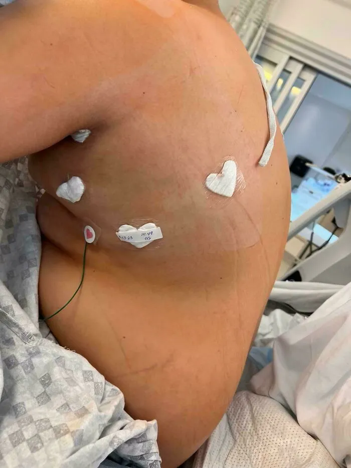 My Wounds After A Surgery To Help My Heart Were Covered By Heart Shaped Gauze