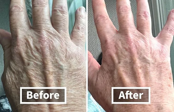 Say Goodbye To Crepey Skin And Hello To Radiant, Youthful-Looking Limbs With The   <a Style="Display:inline;" Href="Https://Www.amazon.com/Gold-Bond-Corrector-Smoothing-Concentrate/Dp/B08yqx3skh?ie=utf8&linkcode=ll1&tag=bpcrab-20&linkid=08bf09954cda9fd6e404b2960387e5eb&language=en_us&ref_=as_li_ss_tl" Target="_blank"><span Style="Font: Inherit; Color: #d74b1f;"> Crepe Corrector Body Lotion</Span>, A Luxurious Treatment That Plumps, Firms, And Nourishes Dry Skin